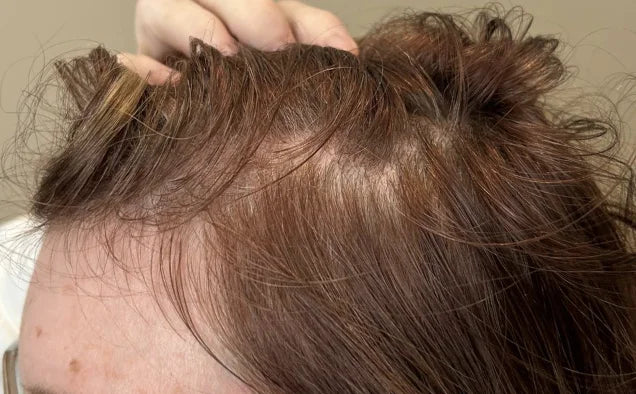 Before: Baseline (Day 0) — 52 Year-Old Female. Participant used Xtressé Hair Growth Gummies and Minoxidil during the assessment period