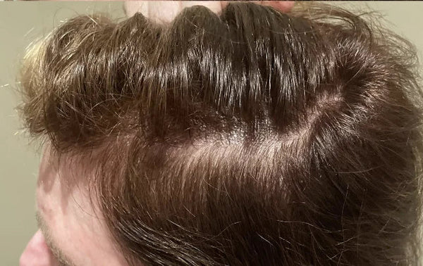 52 YEAR-OLD FEMALE. PARTICIPANT USED XTRESSÉ HAIR GROWTH GUMMIES AND MINOXIDIL DURING THE ASSESSMENT PERIOD