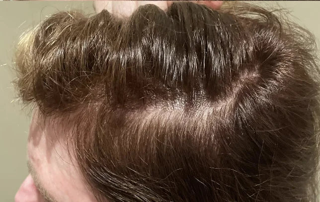 After: Month Three — 52 Year-Old Female. Participant used Xtressé Hair Growth Gummies and Minoxidil during the assessment period