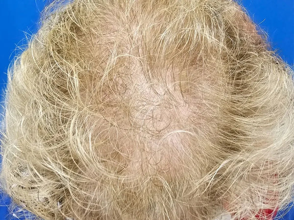 64 YEAR-OLD FEMALE. DAILY USE HAIR GROWTH GUMMIES